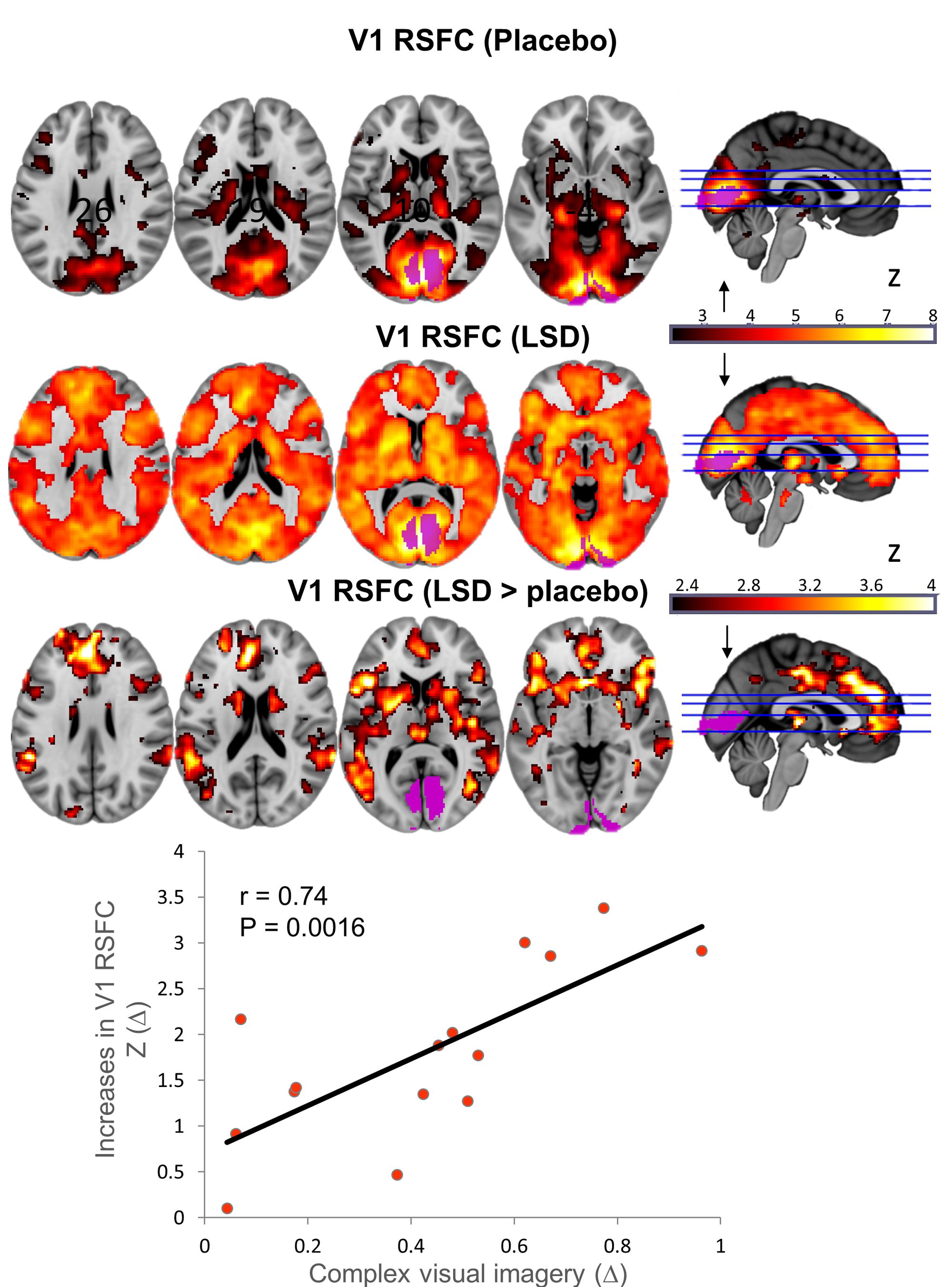 LSD brain scan images
